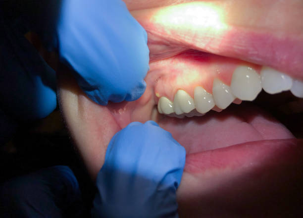 Best Emergency Denture Repair in Midland, WA
