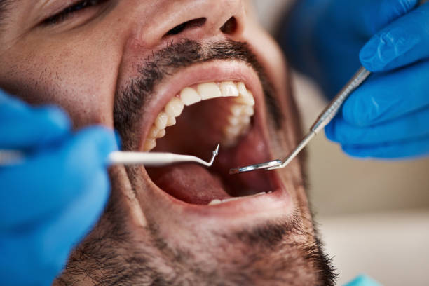 Best Emergency Treatment for Dental Infections or Abscesses in Midland, WA